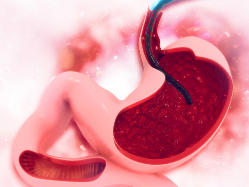a imagem ilustra um estômago e dentro dele um aparelho endoscópio realizando o exame