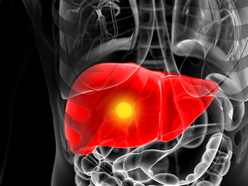 Imagem ilustra a parte interna do corpo humano, destacando o fígado em vermelho e um nódulo ilustrado na cor amarela.
