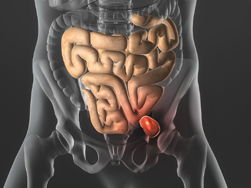 Imagem ilustra a parte interna do corpo humano destacando a hérnia em vermelho.